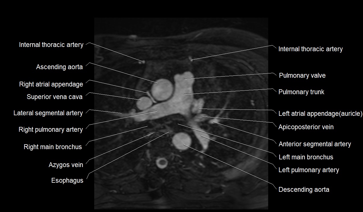MRI heart coronary arteries and coronary veins anatomy axial image 5.jpg